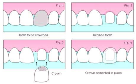 diagram of hornsby dental crowns figure