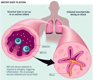 diagram of how asthma happens