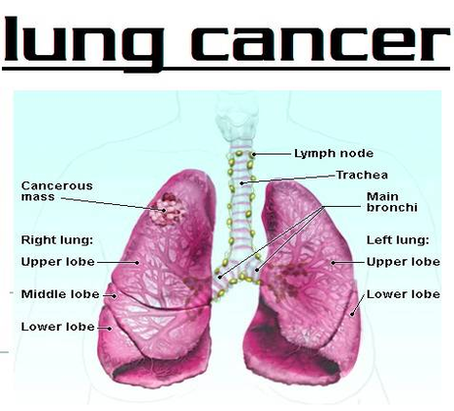 diagram of lung cancer new