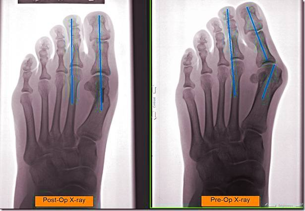 diagram of post op ray of painful bunion thumb