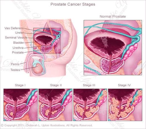 diagram of prostate cancer