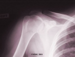 diagram of shoulder instability xray