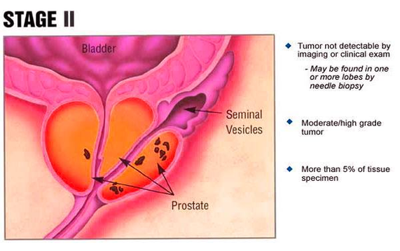 diagram of stage ii prostate cancer