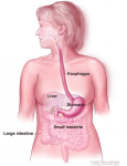 diagram of stomach cancer gastric