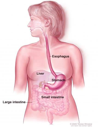diagram of stomach cancer gastric