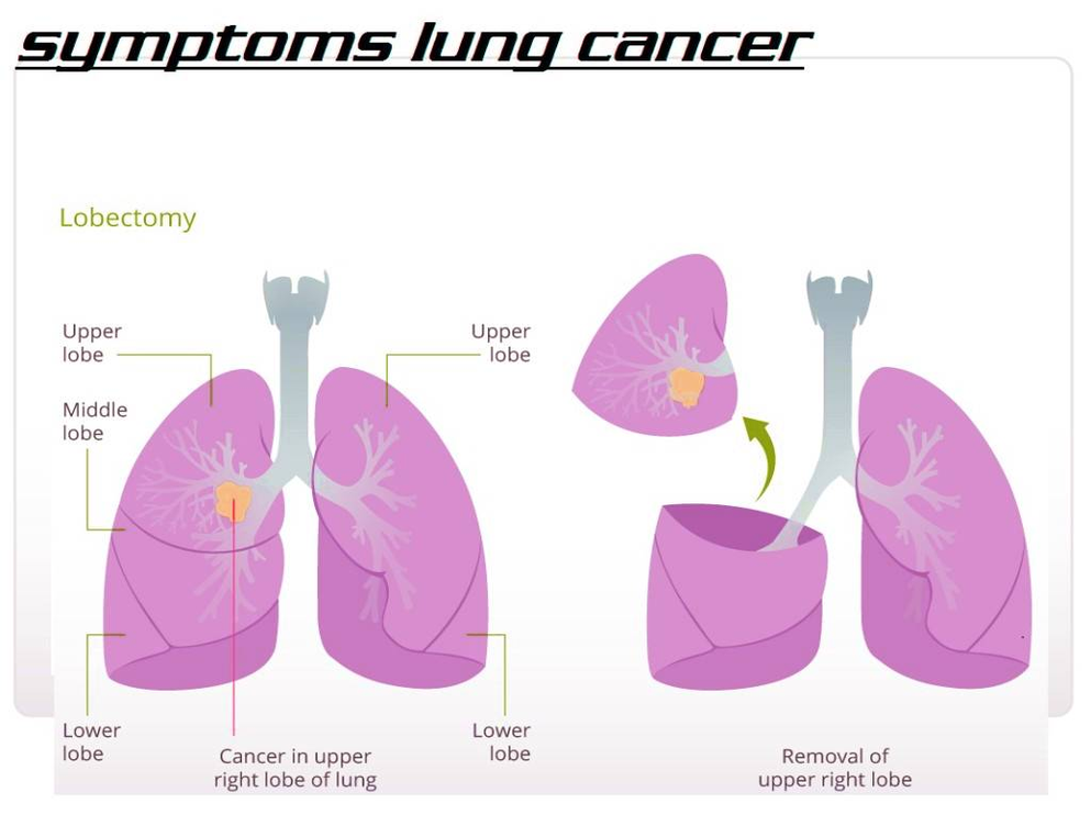 diagram of symptoms lung cancer 1024x817