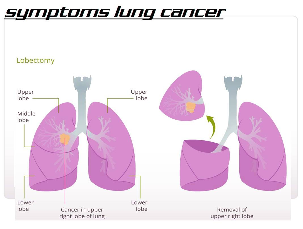 diagram of symptoms lung cancer