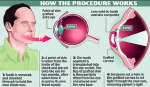 diagram of tooth implant procedure