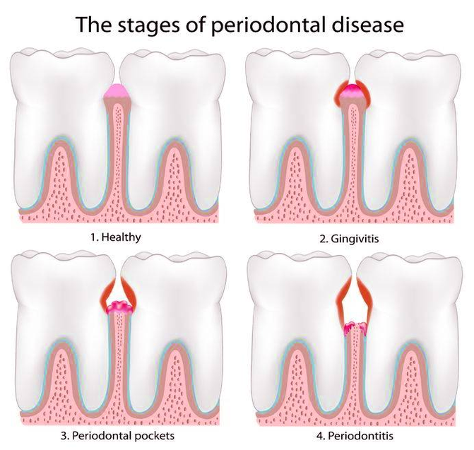 diagram periodontal disease stages
