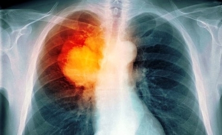 diagram princ rm lung cancer xray