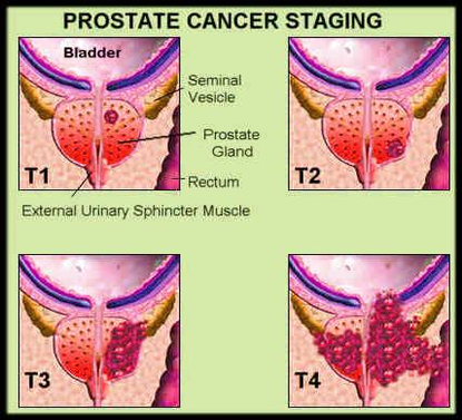 diagram prostate cancer stages