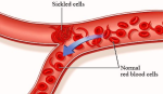 diagram sickle cell disease