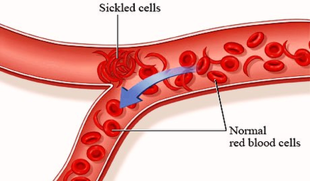 diagram sickle cell disease