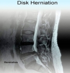 disc herniation