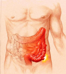 diverticulitis diagram