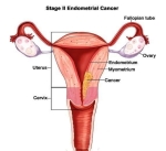 endometrial cancer metastasis to bone jvrucwgo