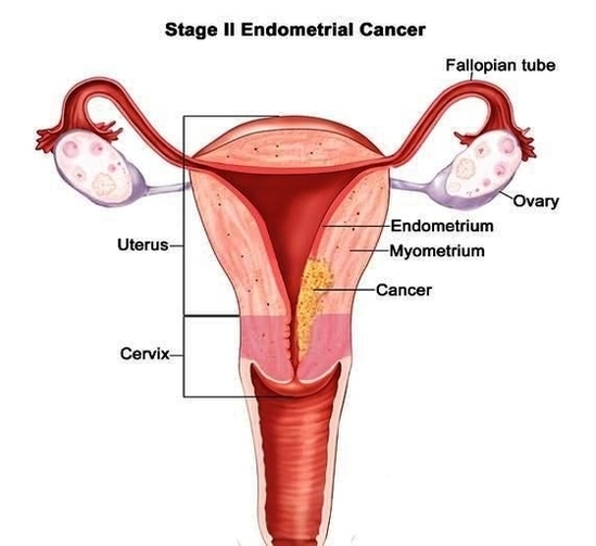 endometrial cancer metastasis to bone jvrucwgo