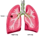 fluid in lung causes cancer symptoms smoking stages ii