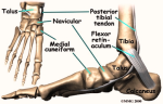 foot accessory navicular anat