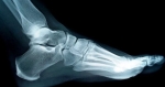 foot bones xray ed