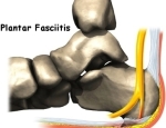 foot plantar fasciitis intro