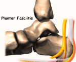 foot plantar fasciitis intro