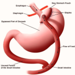 gastric bypass diagram