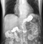 gastroesophageal reflux barium ray