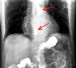 gastroesophagealrefluxbariumx ray