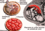 gestational diabetes baby figure