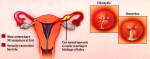 gonnorhea and chlamydia diagram