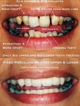 gum disease closeup