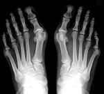 hallux valgus ray