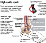 high ankle sprain