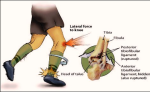 high ankle sprain cause diagram