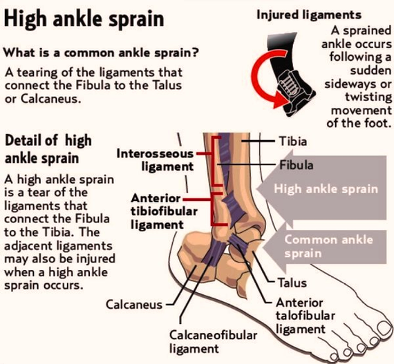 high ankle sprain illustration photos