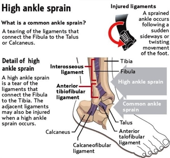 high ankle sprain