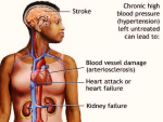 high blood pressue symptoms