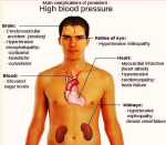 high blood pressure complic photos