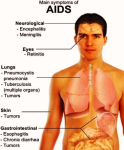 hiv aids symptoms figure