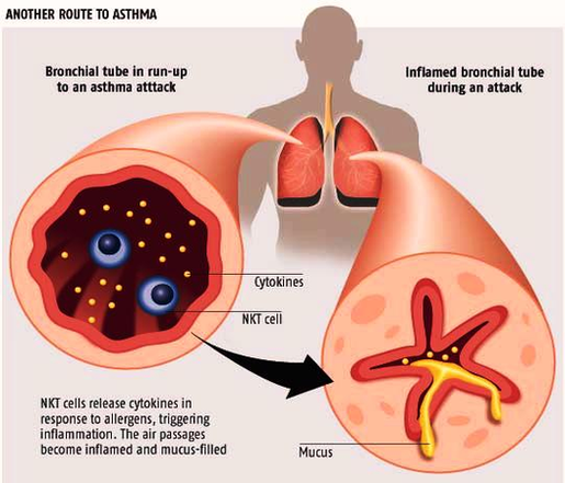 how asthma happens diagram