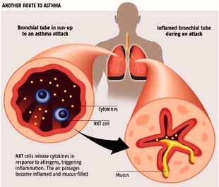 how asthma happens