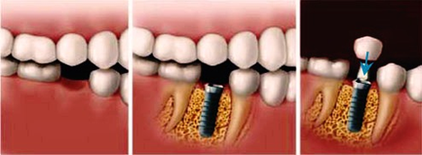 how do dental implants work