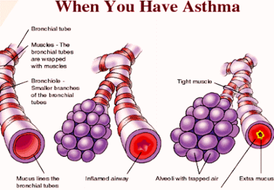 how you get asthma photo