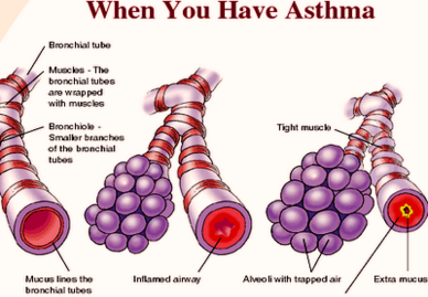 how you get asthma