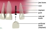 immediate load implants photo