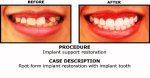 implant before and after