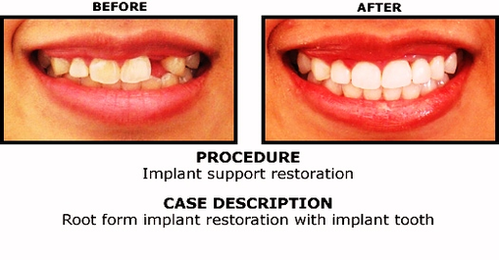 implant before and after