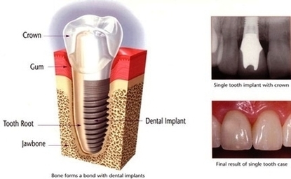 implant supported replacement teeth