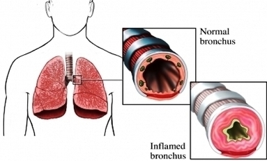 inflammed lung asthma image